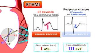 Ischemia 67  STEMI on ECG [upl. by Verna]