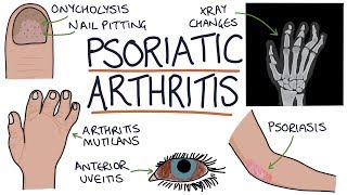 Psoriatic Arthritis [upl. by Hgielime]