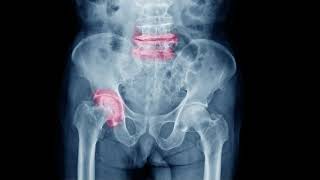 Osteoarthritis in the Hips [upl. by Sacken]