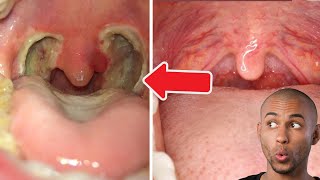 Tonsil Stone  Tonsillectomy [upl. by Faux]