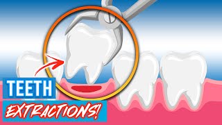 Tooth Extractions For Braces  Why Do Orthodontists Extract Teeth [upl. by Joshia109]