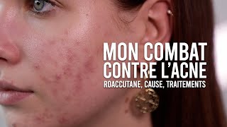 MON COMBAT CONTRE LACNÉ CAUSE TRAITEMENTS amp MON AVIS SUR ROACCUTANE [upl. by Way]