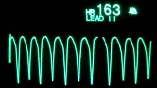 Ventricular Tachycardia [upl. by Susannah]