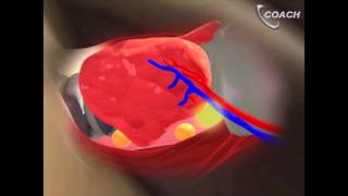 Minimally Invasive Total Thyroidectomy Video [upl. by Zilber763]