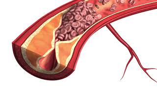 Atherosclerosis  Plaque Animation Model [upl. by Alroy333]