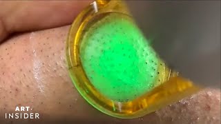 Laser Zaps Out Ingrown Hairs  Art Insider [upl. by Ymaral]