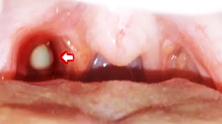 Worlds Greatest Tonsil Stone Removals 2 [upl. by Andres]