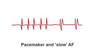 Pacemaker Issues Explained Part 2 Decoding Undersensing [upl. by Hollyanne]