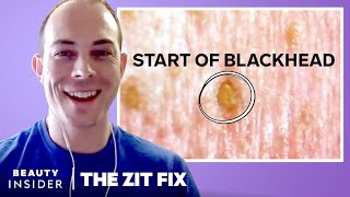 Dermatologist Explains What We See In Our Pores Under A Microscope  The Zit Fix [upl. by Lankton]