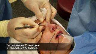 Percutaneous Osteotomy amp Breaking the Nose During Rhinoplasty Surgery [upl. by Aimehs]