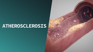 Atherosclerosis  Pathologies [upl. by Adlig]