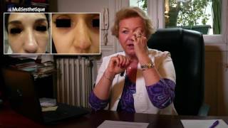 Rhinoplastie médicale  retoucher son nez sans bistouri – Dr Catherine de Goursac [upl. by Llenrad]