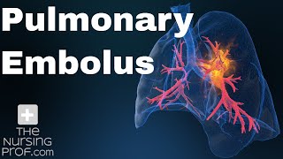 Pulmonary Embolus Nursing Care [upl. by Sande]