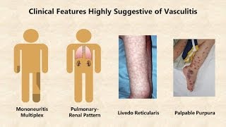 Vasculitis  An Overview [upl. by Leahcar558]