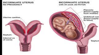 Congenital Uterine Anomalies part 2  Septate and Bicornuate Uterus  Sonographic Features [upl. by Annadroj949]