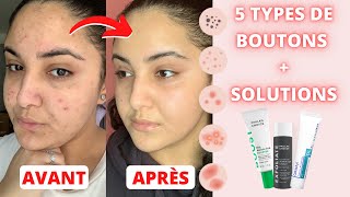 LACNÉ  MA ROUTINE SKINCARE  TOUTES LES SOLUTIONS POUR CHAQUE TYPE DE BOUTON [upl. by Armallas]