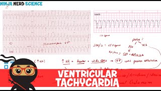 Rate and Rhythm  Ventricular Tachycardia [upl. by Scammon]