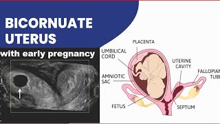 Bicornuate Uterus with early pregnancy [upl. by Coppock]