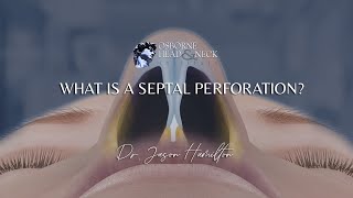 What is a septal perforation [upl. by Eybbob469]