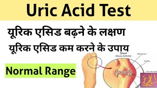 Uric Acid Test in Hindi  uric acid treatment  uric acid symptoms [upl. by Earesed344]