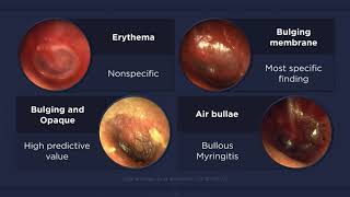 Acute Otitis Media Otoscopic Findings [upl. by Wiener602]