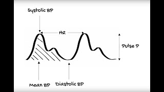 Invasive Arterial Blood Pressure Measurement [upl. by Reitrac]