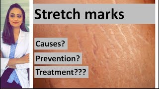 Stretch marks causes prevention treatment  Dermatologist  Dr Aanchal Panth [upl. by Yhtorod]