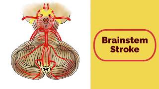 Brainstem Stroke Syndromes [upl. by Adranoel358]