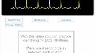 ECG Rhythm Review of 14 common rhythms [upl. by Duomham592]