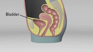 Cystocele amp Rectocele [upl. by Mabelle]