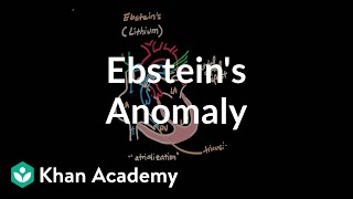 Ebsteins anomaly  Circulatory System and Disease  NCLEXRN  Khan Academy [upl. by Yesima]