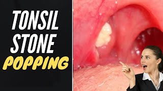 Big Tonsil Stone Removal [upl. by Mechelle931]