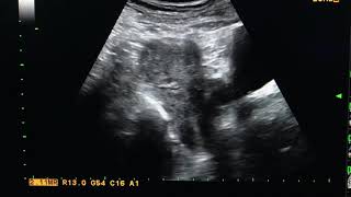 Complete bicornuate uterus USG Ultrasound [upl. by Hope]