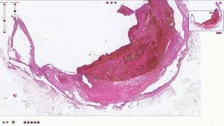 Atheromatous Plaque with Thrombosis  Histopathology [upl. by Terrye]