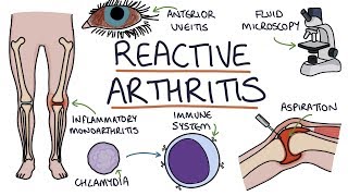 Understanding Reactive Arthritis [upl. by Nyloc86]