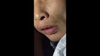 Orofacial Dyskinesia [upl. by Ihc235]