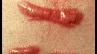 DermTV  How to Treat a Keloid Scar DermTVcom Epi 279 [upl. by Almeta]