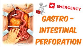 Gastrointestinal Perforation [upl. by Savory929]