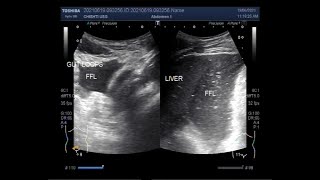 Intestinal Obstruction with perforation [upl. by Hanavas]