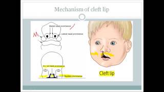 Cleft Palate Complications in Adulthood Fixed by a Prosthodontist [upl. by Tobye846]