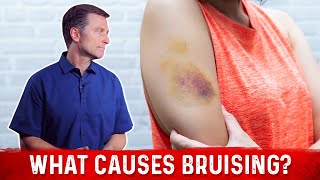 What Causes Bruising Without Trauma – Dr Berg [upl. by Lebazi]