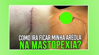 MASTOPEXIA COMO IRA FICAR MINHA ARÉOLA CIRURGIA PLÁSTICA [upl. by Hallimaj]