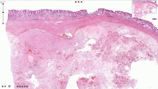 Gastrointestinal Stromal Tumor GIST  Histopathology [upl. by Oijimer]