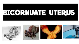 Bicornuate Uterus  50 Second Short  Images [upl. by Nyvlem]