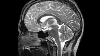 The Ventricles Neuroanatomy Video Lab  Brain Dissections [upl. by Llednav]